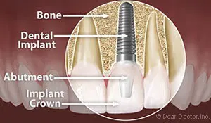 Dental Implants